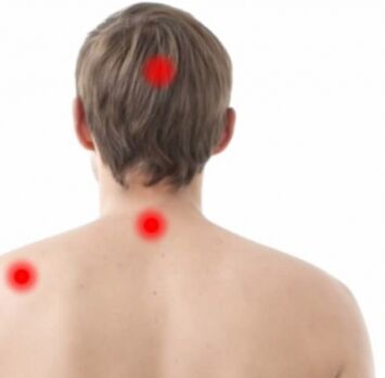 Focos de osteocondrosis