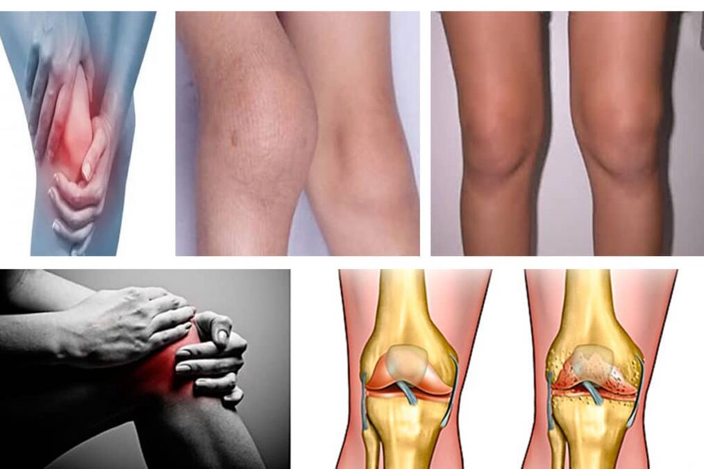 Síntomas de la artrosis de la rodilla